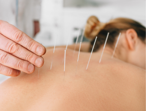 acupuntura